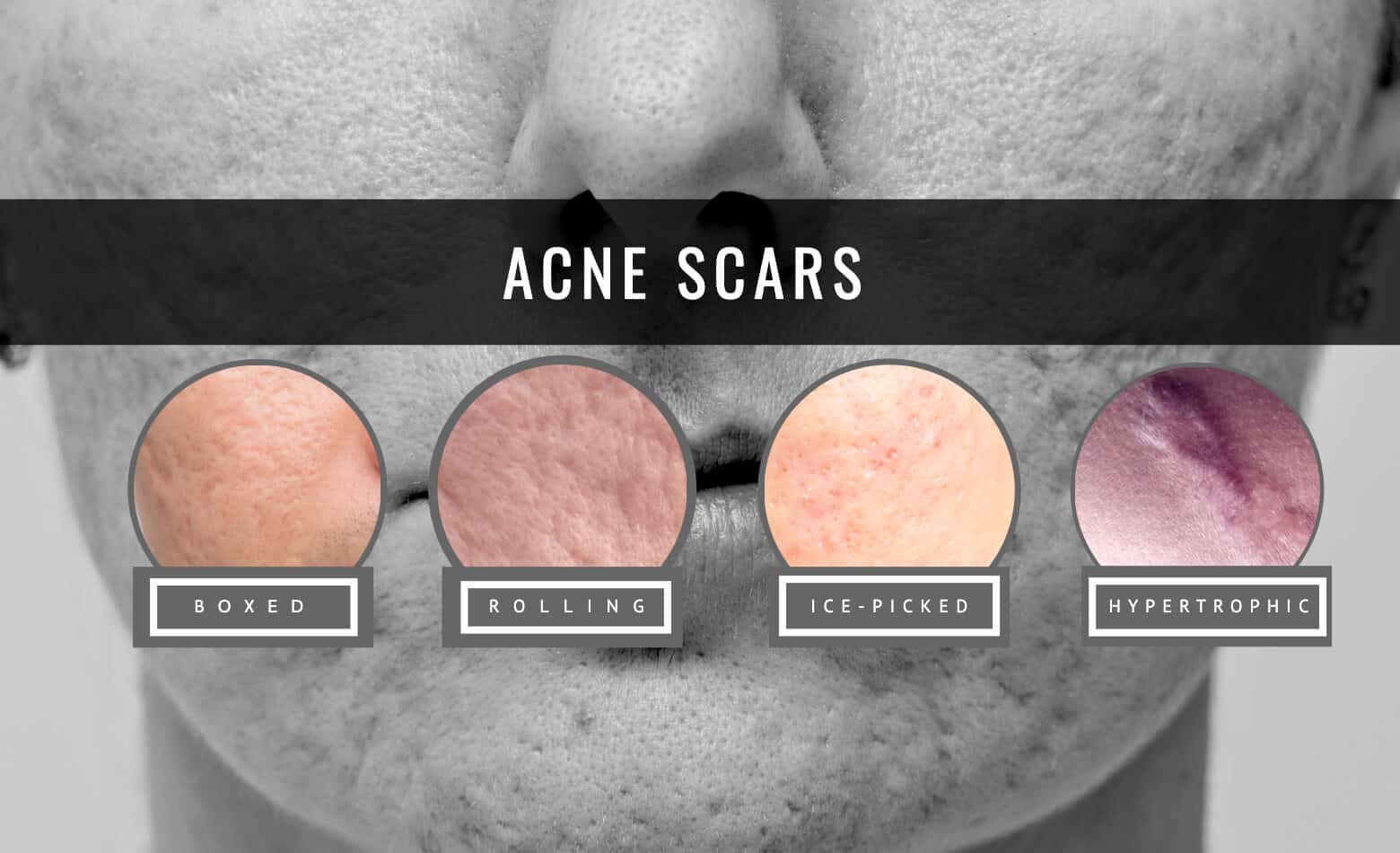 types of acne scars and the treatment and pimple scar removal
