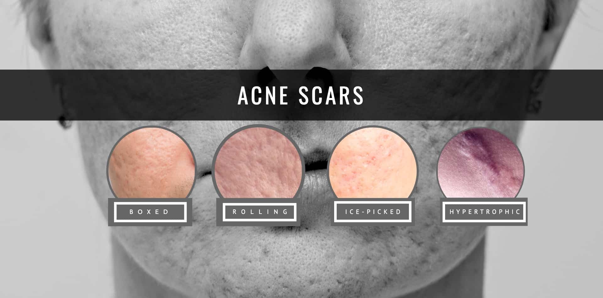 types of acne scars and the treatment and pimple scar removal