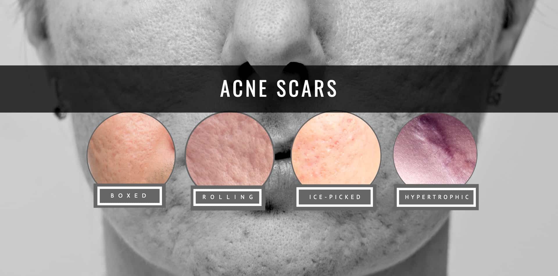 types of acne scar and how microneedling can help to treat the pimple scar