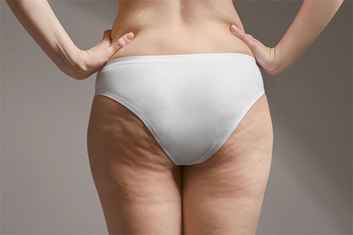 photo of a women with a cellulite grade 2 issue