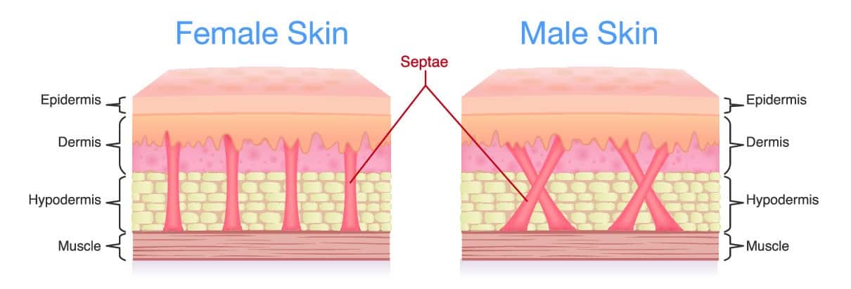 Cellulite diagram for Female and Male