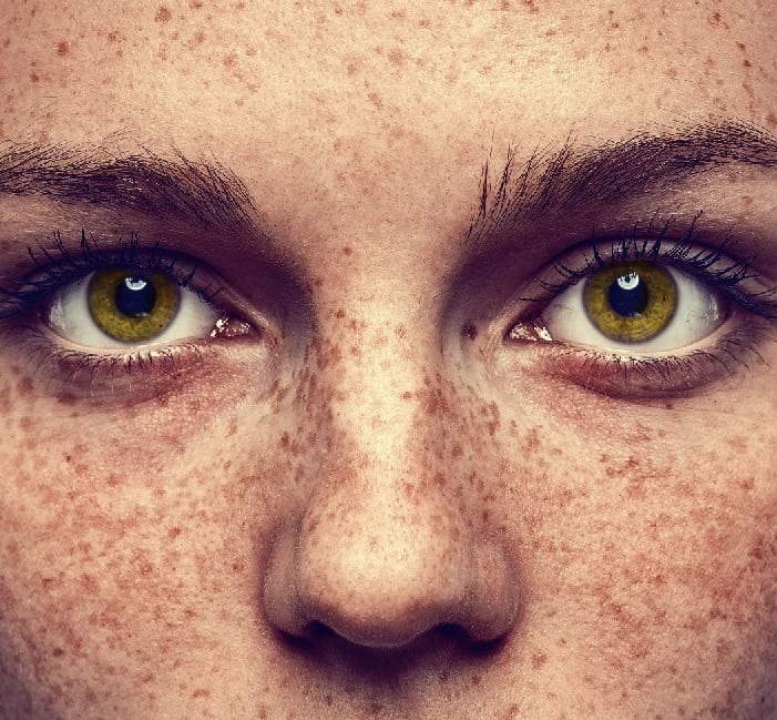 freckles spot on a women's face which she wants to get it remove