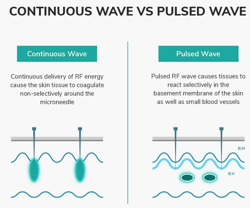 RF Microneedling Sylfirm Wave vs Pulsed Energy diagram