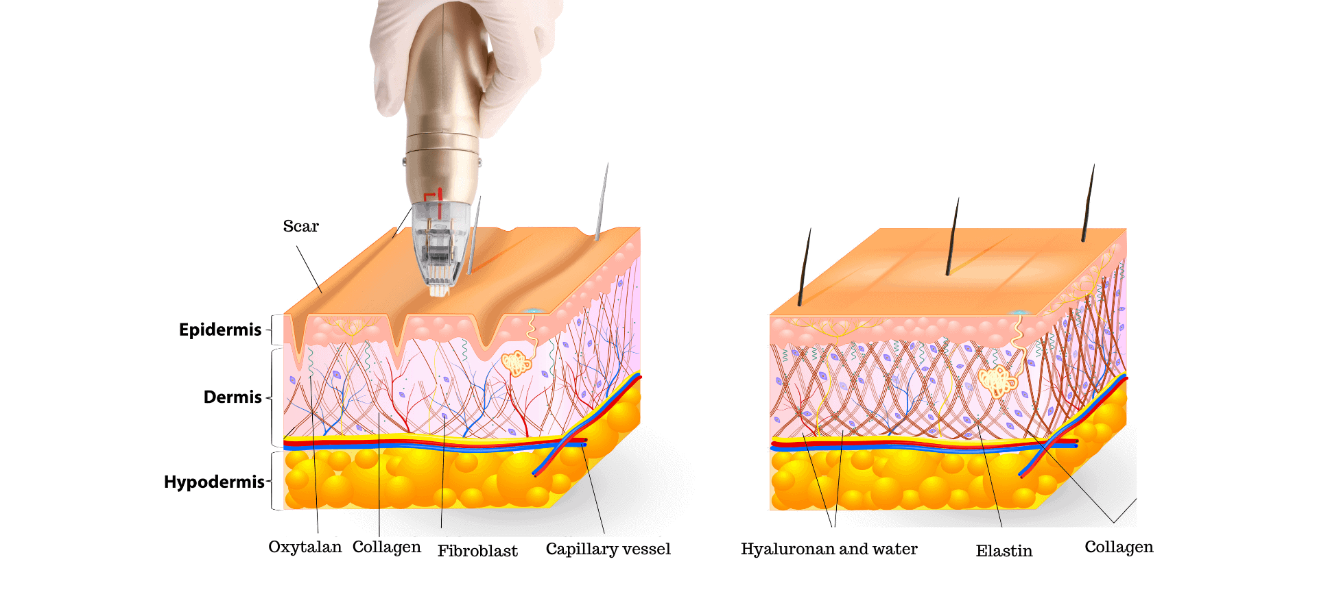 detail skin scar surface diagram