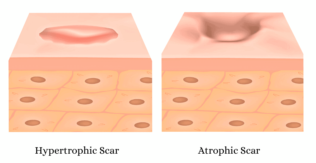 hypertrophic and atrophic acne scars images
