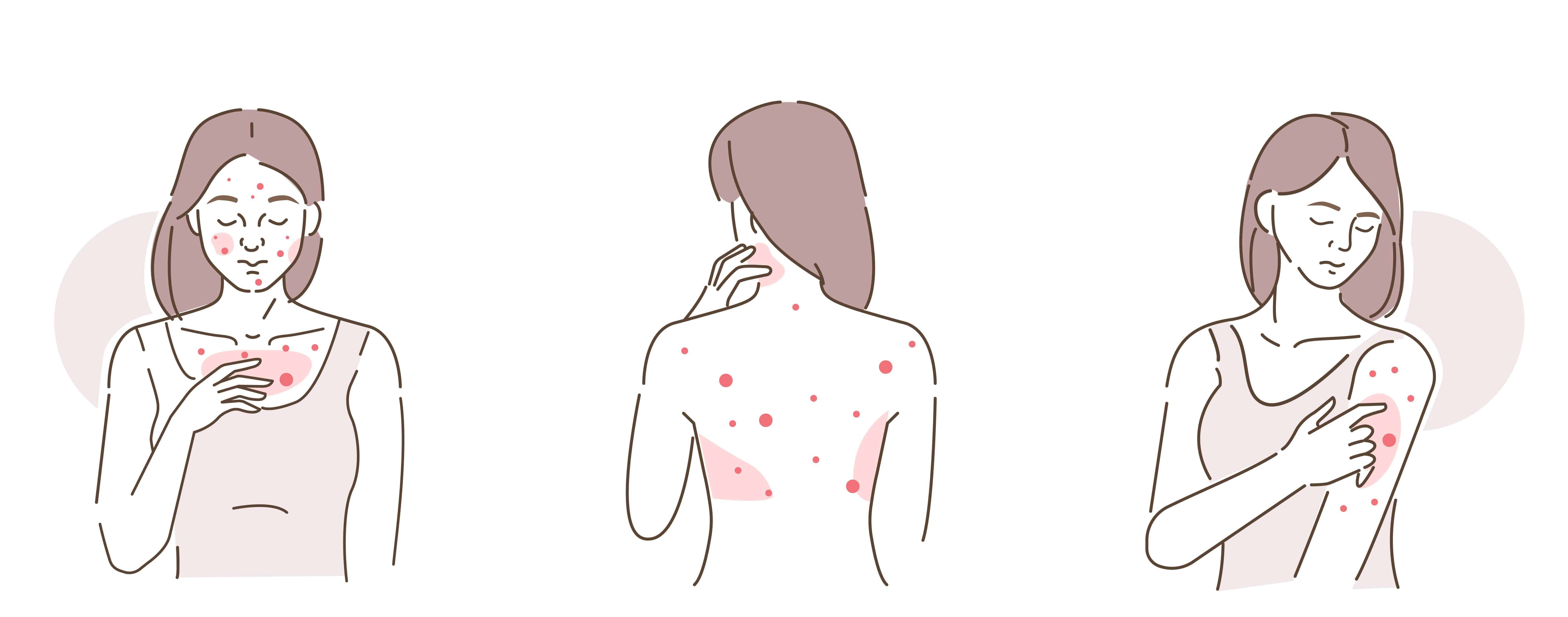 severe back acne bacne, arm acne and body acne