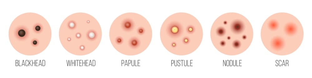 types of acne and pimple problems