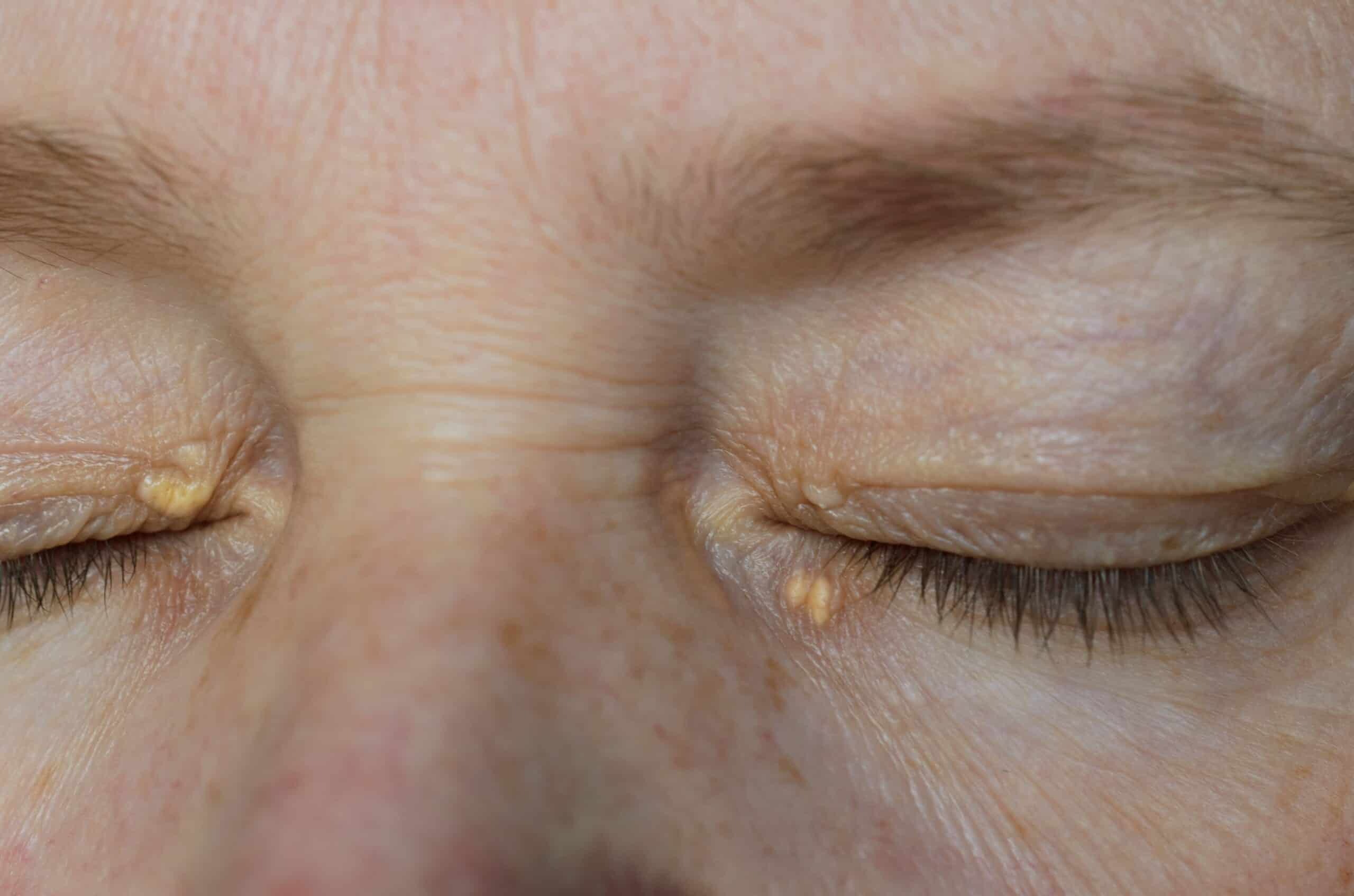 a women with a Xanthelasma 黄斑瘤 issue