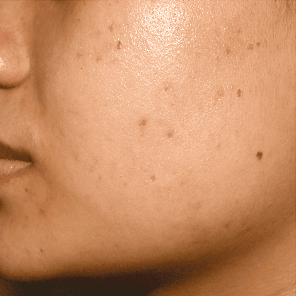 hyperpigmentation image of a girl