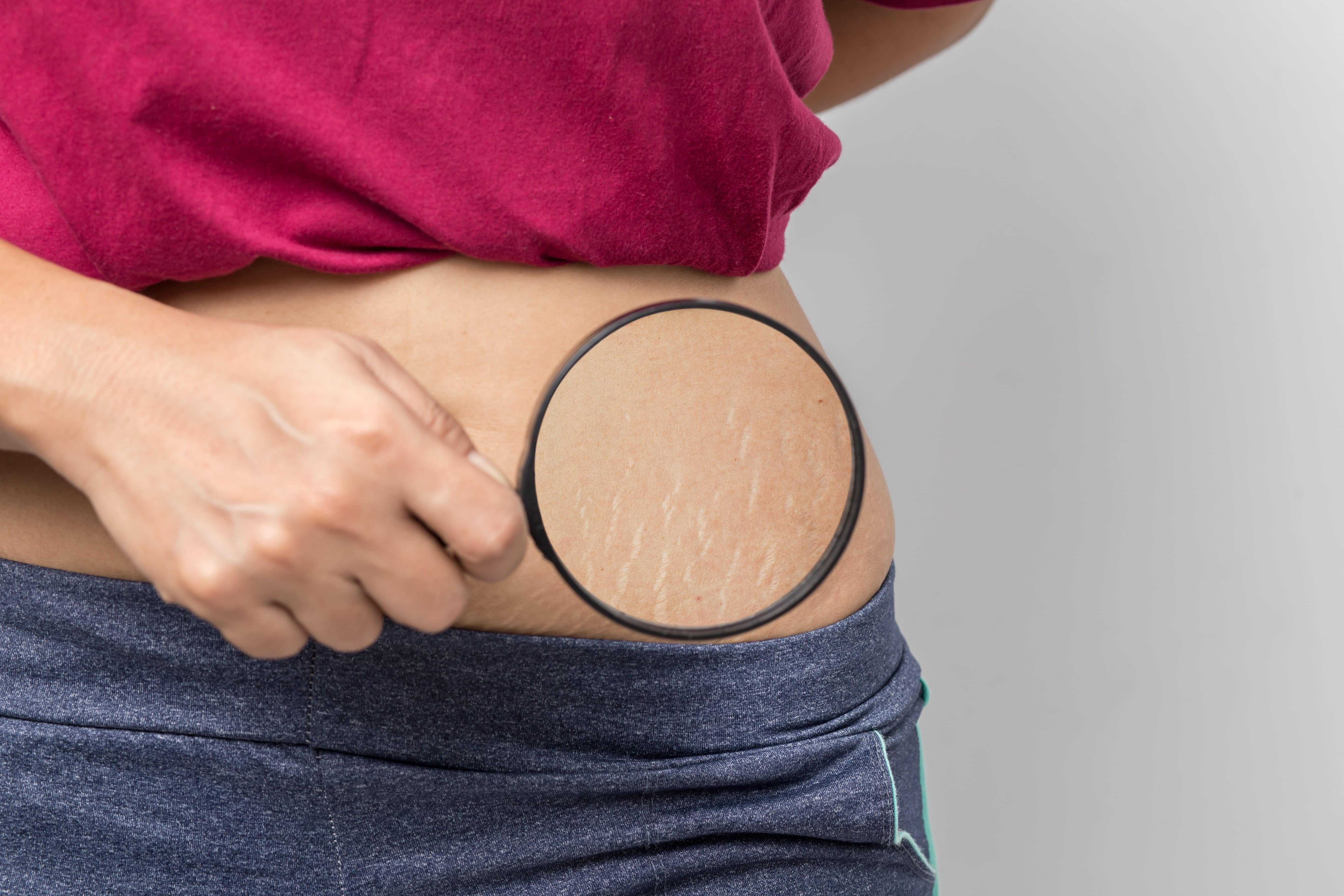 woman using magnifying glass to show stretch marks