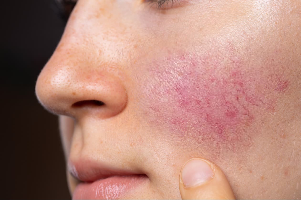 Rosacea treatment removal redness acne veins spider singapore