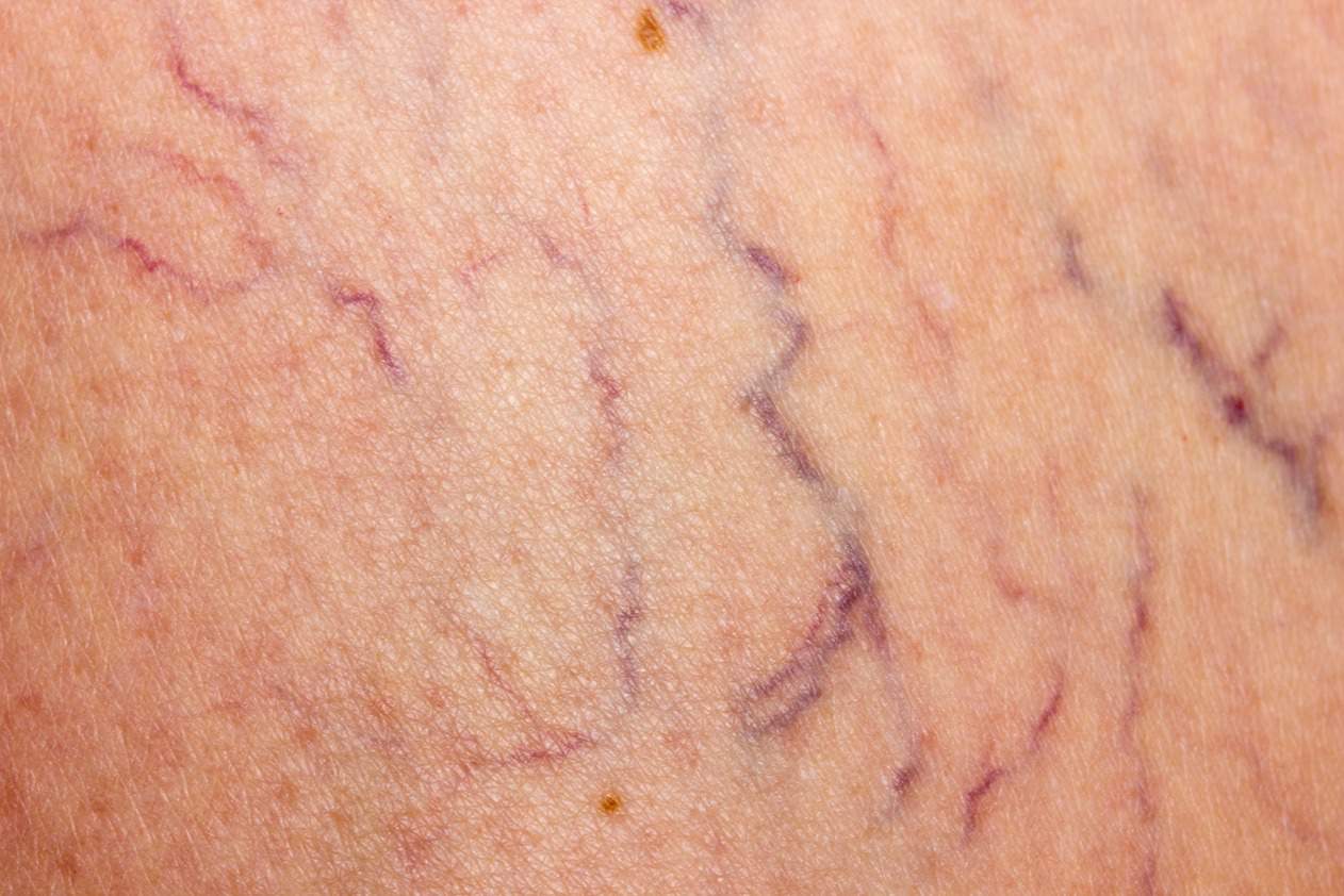 Spider veins removal treatment redness acne