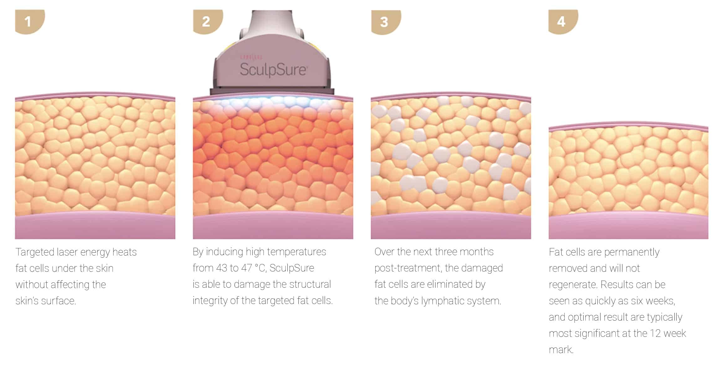 numbered-sculpsure-diagram-english-min