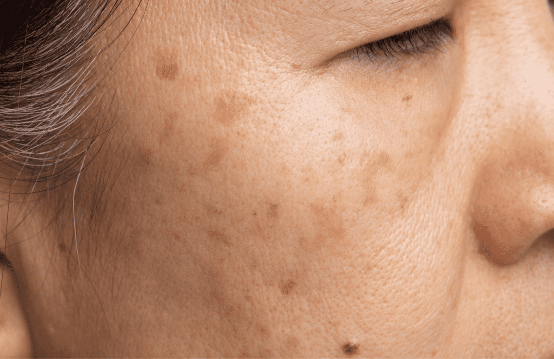pigmentation_woman_age_spots_sun_spots_liver_spots