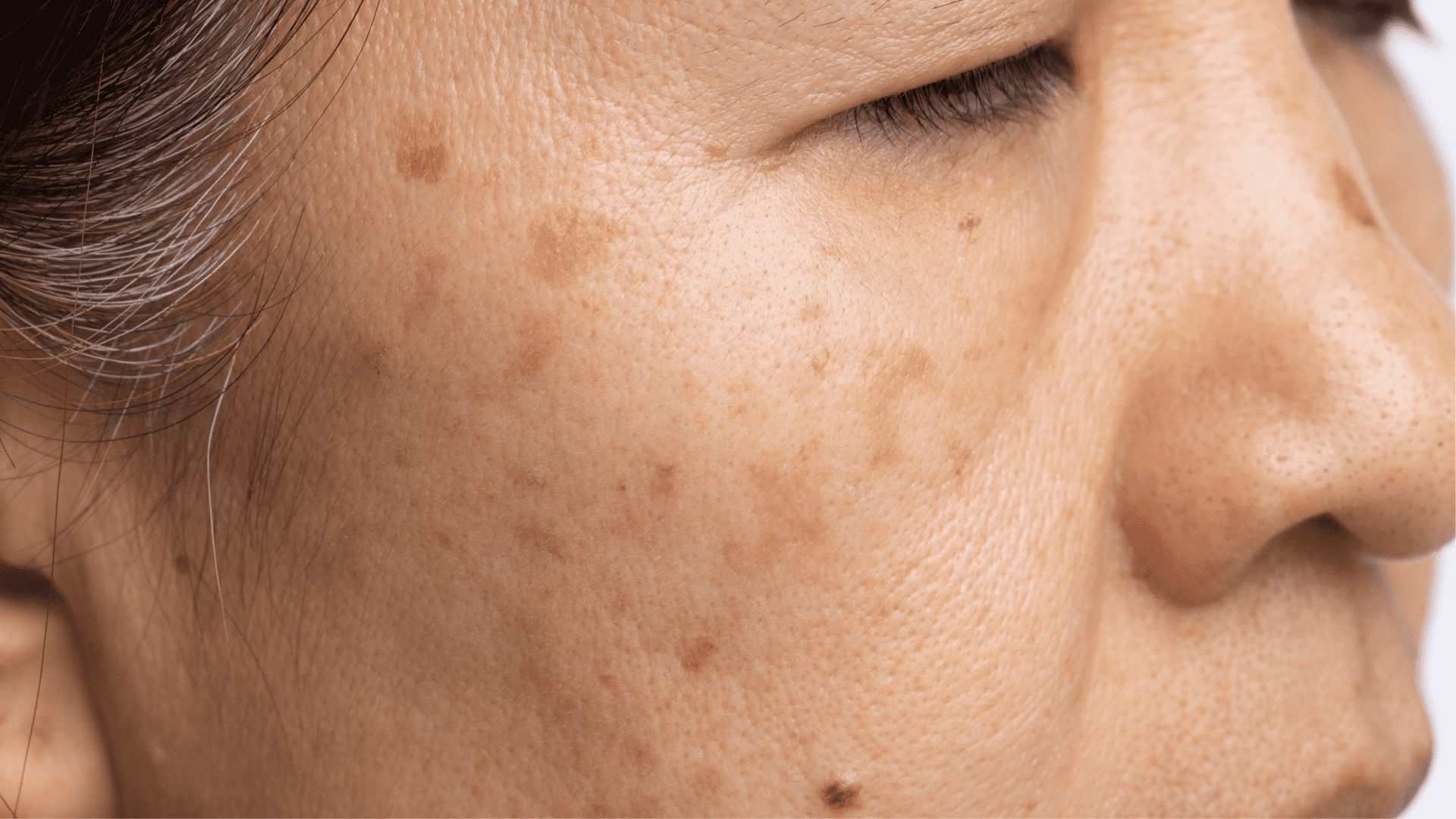 pigmentation_woman_aged_spots