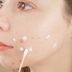 benzoyl-peroxide-acne-spot-treatment