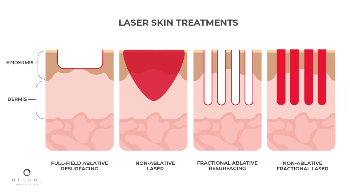 fractional-laser-ablative-lasers-non-ablative-laser-ensoul-clinic