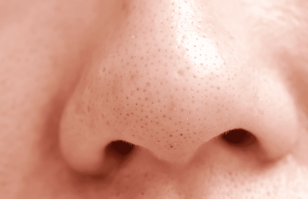 what-is-blackheads-how-to-get-rid-of-blackheads