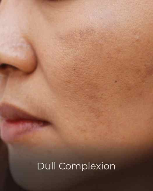 dull-skin-dull-complexion