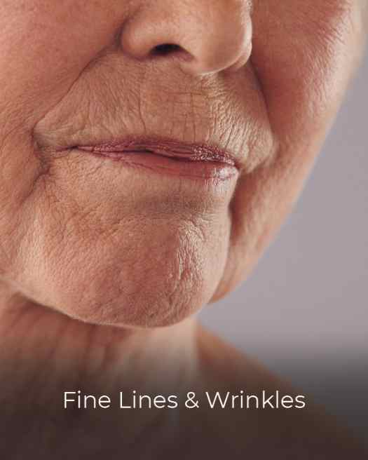 lady-fine-lines-wrinkles-mature-aging-skin
