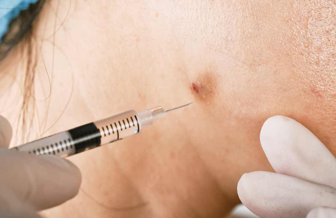 cortisone steroid injection for cystic acne