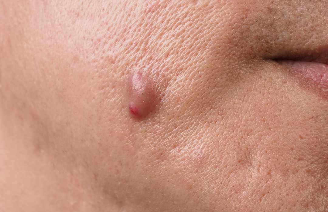 cystic acne nodular acne 