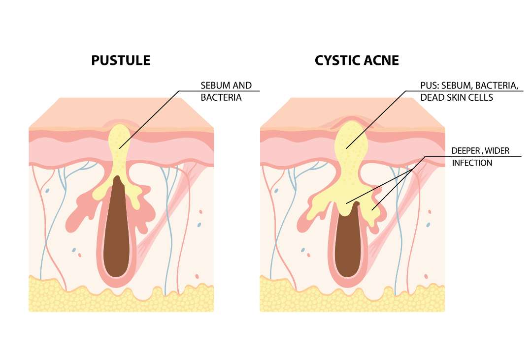 cystic acne nodular acne vs pustule regular acne