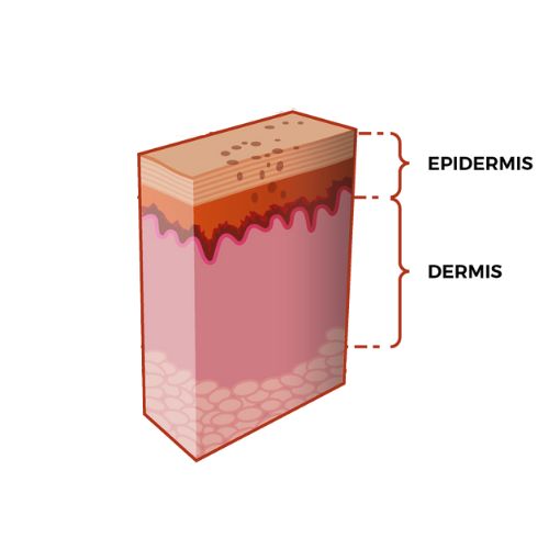Epidermal Pigmentation, Superficial pigmentation, freckles, sunspots, melasma, dark spot, pigments, age spots