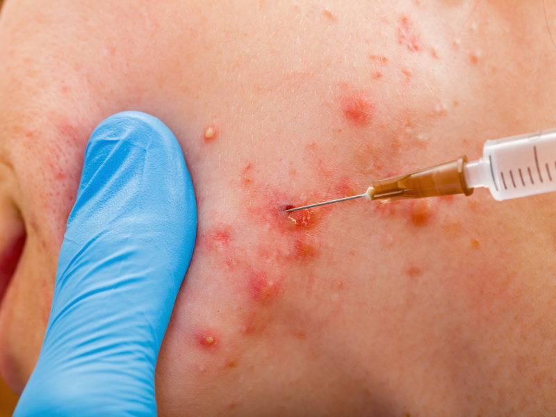 Cortisone Acne injection Singapore, Cystic Acne, Nodular Acne