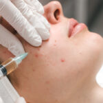 Cortisone Acne Injection, Cystic Acne, Nodular Acne, Ensoul Medical Clinic, Singapore, acne scarring